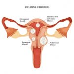 WHMC Fibroid Tumors