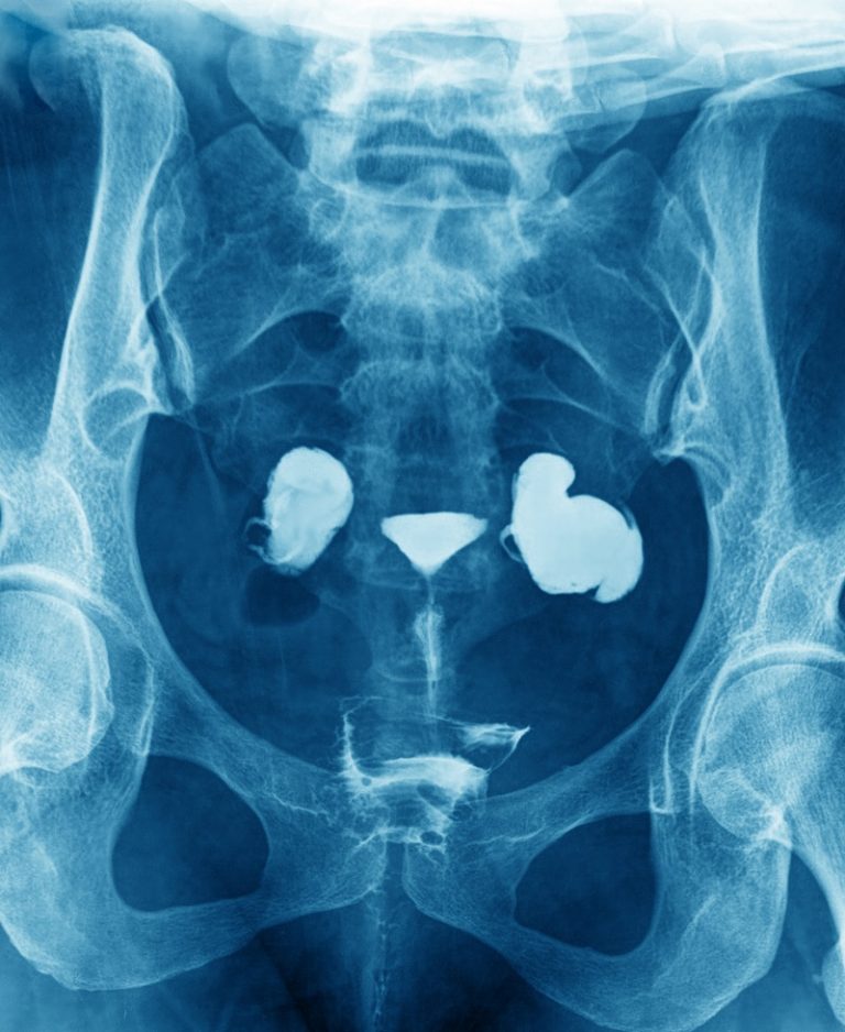 Reasons for Having a Hysterectomy Women's Health and Menopause Center