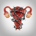 Womens Health and Menopause Center What Is Endometriosis