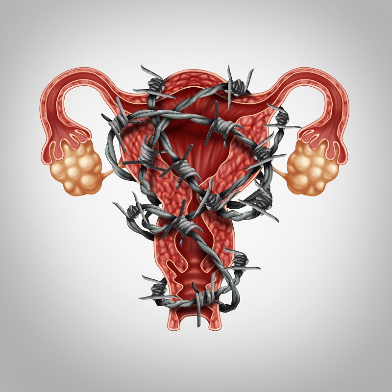 Womens Health and Menopause Center What Is Endometriosis