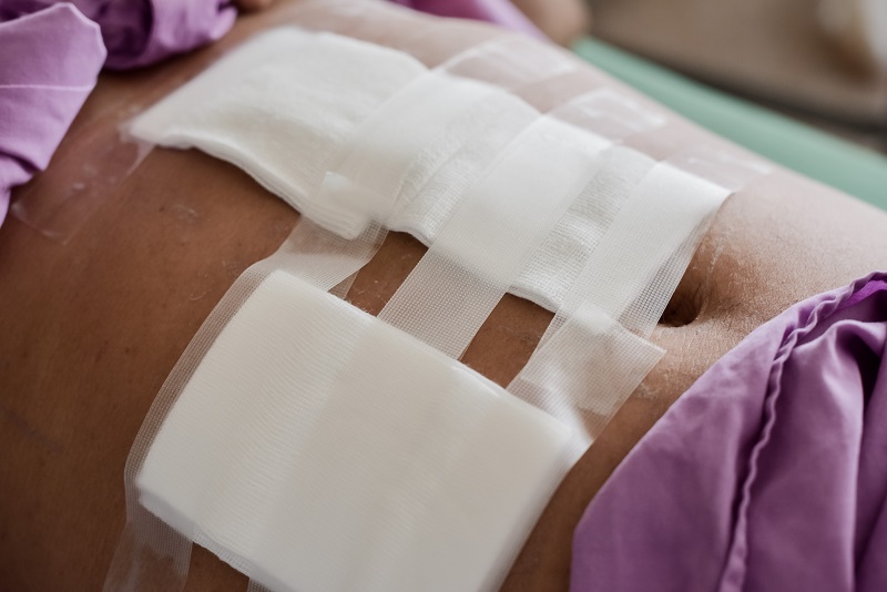 Womens Health and Menopause Center Myomectomy Facts