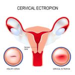 Women's Health and Menopause Center Cervical Ectropion