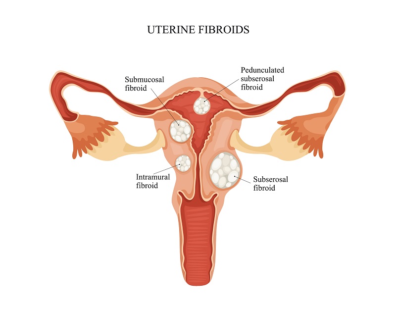 WHMC Fibroid Tumors