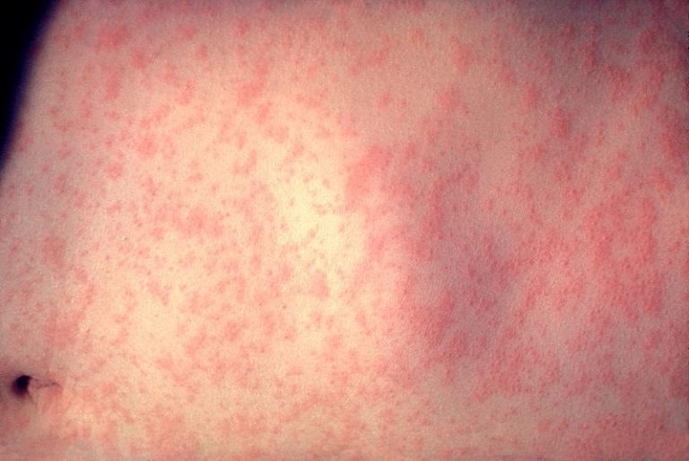 Measles Outbreaks