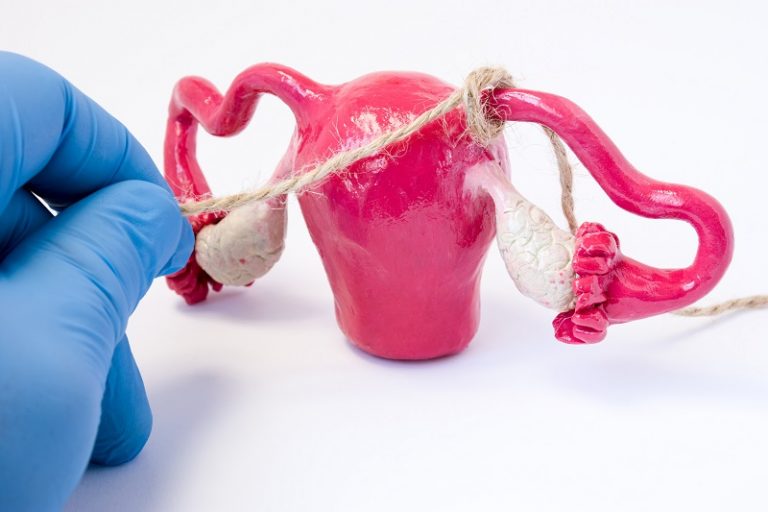 What Are the Pros and Cons of Tubal Ligation? Women's Health and