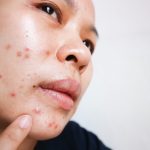 Womens Health Pregnancy and Acne