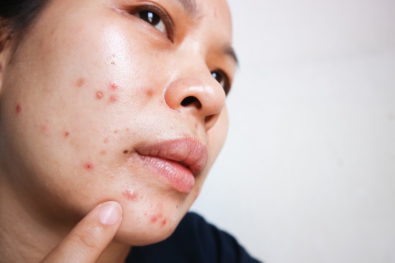 Dealing with Pregnancy Breakouts