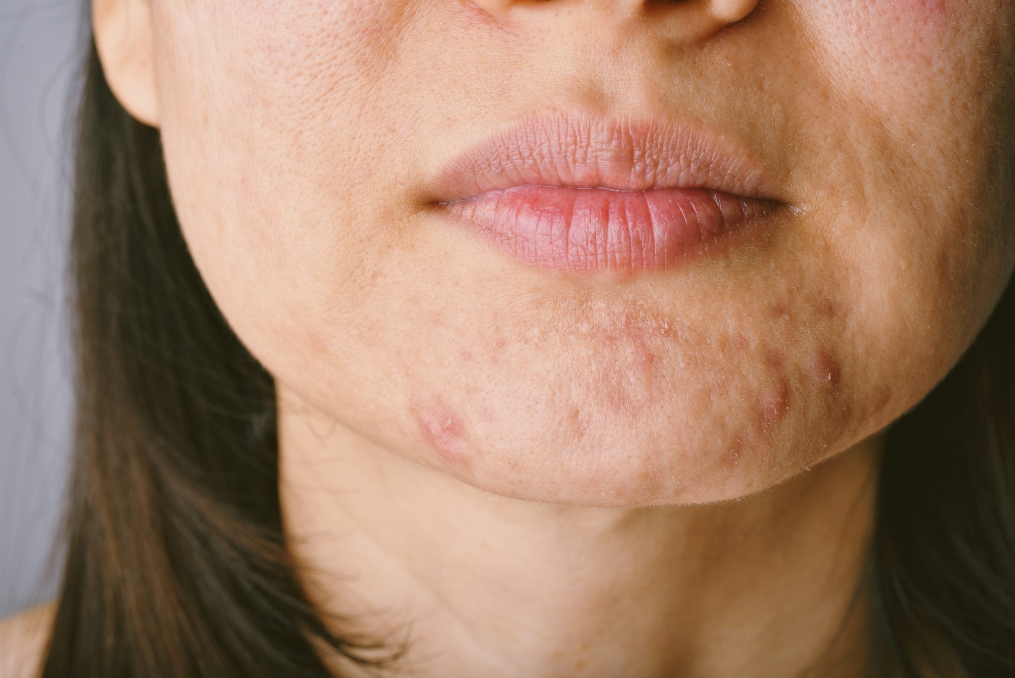 6 Ways To Manage Acne During Menopause